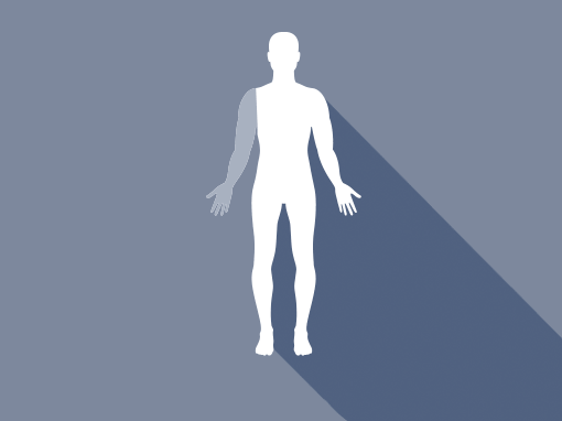 Forequarter-protese / FA (Forequarter amputation)