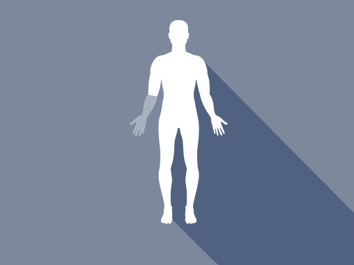Albueprotese / ED (Elbow disarticulation)