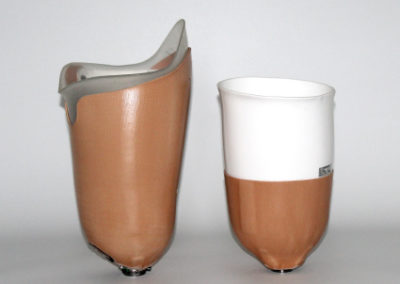 SIS hylsterteknik til lårbensamputerede beviser sit værd