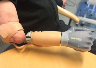 Osseointegreret armprotese